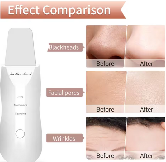 Ultrasonic Skin Scraper Peeling Blackhead Remover Deep Face Cleaning